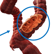 Diverticulite